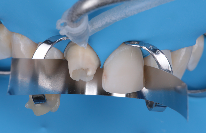 Vorbehandlung des Kompositaufbaus durch Sandstrahlen mit 30 µm Aluminiumoxid. Bilder mit freundlicher Genehmigung von Dr. Paulo Monteiro.